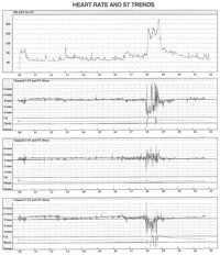 EKG:n pitkäaikaisrekisteröinnissä seurataan sydämen rytmiä vuorokauden ajan.