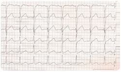 Ekg ennen rytminsiirtoa