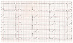 Ekg rytminsiirron jälkeen